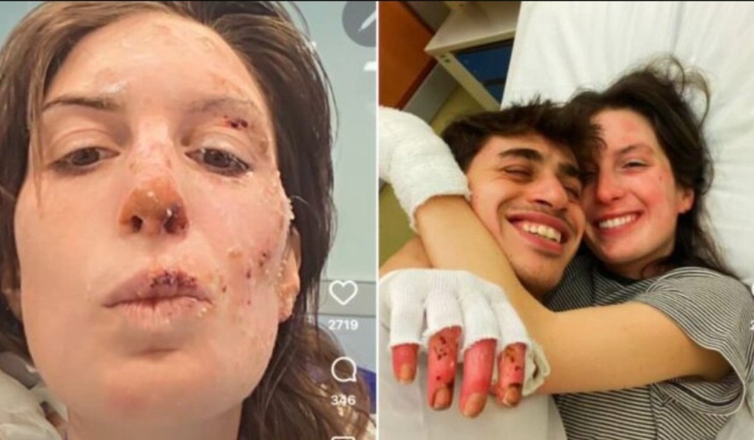 Crans-Montana, Eleonora Palmieri e il coraggio di mostrare le ferite